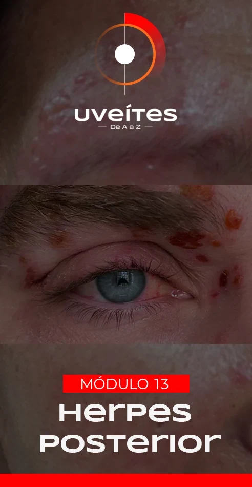 Capas_Aulas_Uveites_V13