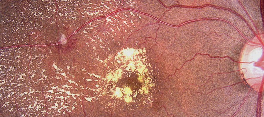 IMAGEM DA SEMANA 

O macroaneurisma arterial retiniano é uma dilatação anômala de uma artéria retiniana, geralmente em pacientes idosos com hipertensão ou doenças vasculares.

A presença de múltiplos exsudatos ao redor e edema de mácula indica vazamento de fluidos e lipoproteínas, levando ao acúmulo de líquido na mácula, a área central da retina responsável pela visão detalhada. 

Isso pode resultar em visão embaçada ou distorcida. O tratamento pode incluir controle rigoroso da pressão arterial e, em alguns casos, intervenção direta como fotocoagulação a laser para selar o aneurisma.

Saber disso tudo é essencial para um oftalmologista que quer ser referência! Então, para te auxiliar nós temos a “Avaliação Clínica da Retina”, uma atualização personalizada para quem deseja elevar o conhecimento e entender - de vez - todas as funcionalidades das ferramentas que devem ser usadas no diagnóstico.